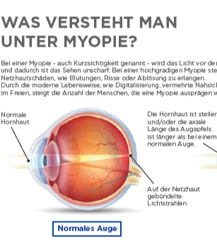 Myopie_Thumbnail_Einleger-1-1