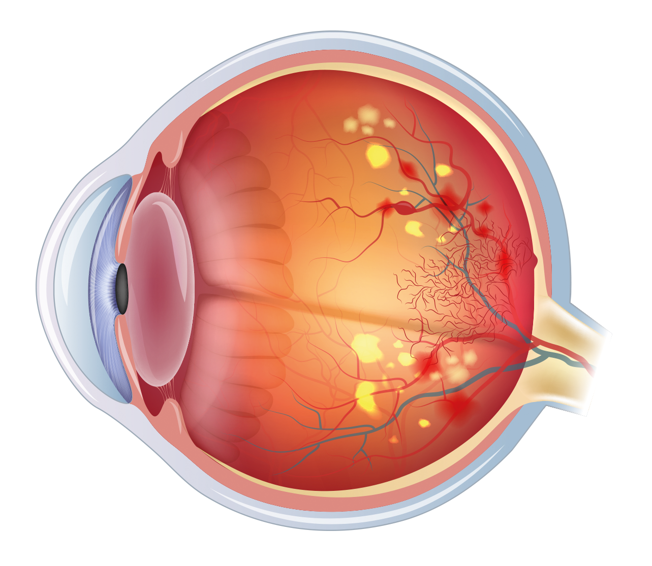 OEIL-SCHEMA-Retinopathy-CristallinCLAIR